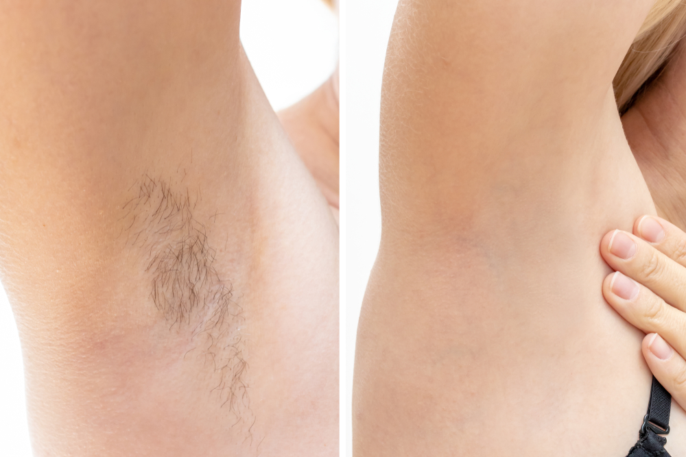 Laser Hair Removal in Issaquah, WA